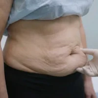 Loose Skin After Weight Loss - 7 Secrets That Change Everything!