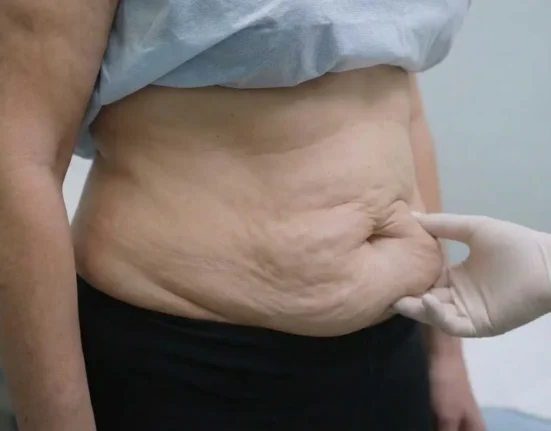 Loose Skin After Weight Loss - 7 Secrets That Change Everything!