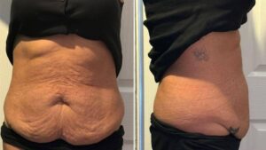 What Loose Skin After Weight Loss Actually Is: