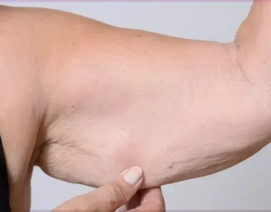 How to Tighten Loose Skin After Weight Loss - 7 Amazing Results!