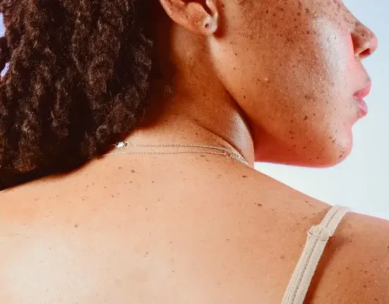 Does Lupus Cause Weight Gain - 7 Honest Truths Revealed!