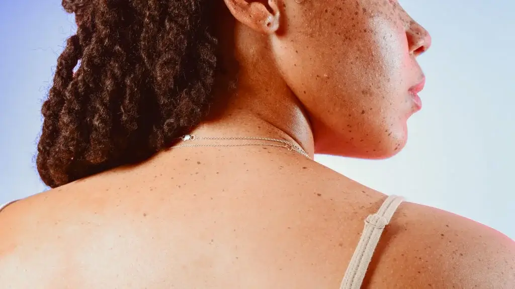 Does Lupus Cause Weight Gain - 7 Honest Truths Revealed!