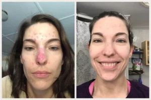 Does Lupus Cause Weight Gain Through Inflammation Alone: