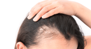 How to Actually Protect Your Hair During Weight Loss: