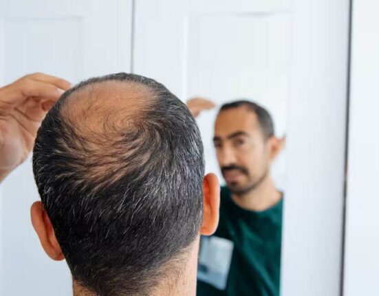 Weight Loss and Hair Loss - 7 Truths Nobody Tells You!