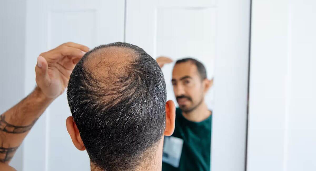 Weight Loss and Hair Loss - 7 Truths Nobody Tells You!