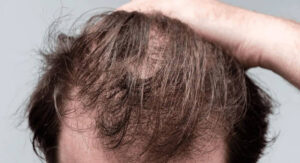 The Nutrient Gaps That Make Weight Loss and Hair Loss Worse: