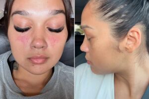 Does Lupus Cause Weight Gain Through Kidney Problems: