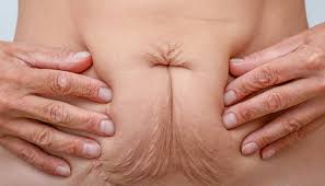 Why Loose Skin Happens and Why This companion Matters