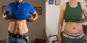 How to Strain Loose Skin After Weight Loss Natural Approaches