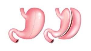 What "average weight loss with gastric sleeve" Actually Means And Why It's deceiving :