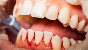 Dentist for Bleeding Gums