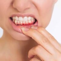 Bleeding Gums - 7 Powerful Causes You Should Never Ignore