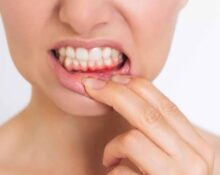 Bleeding Gums - 7 Powerful Causes You Should Never Ignore
